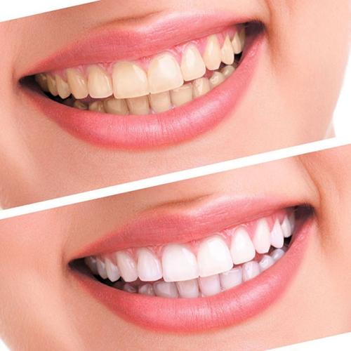 Grin & Gleam Teeth Whitening Kit